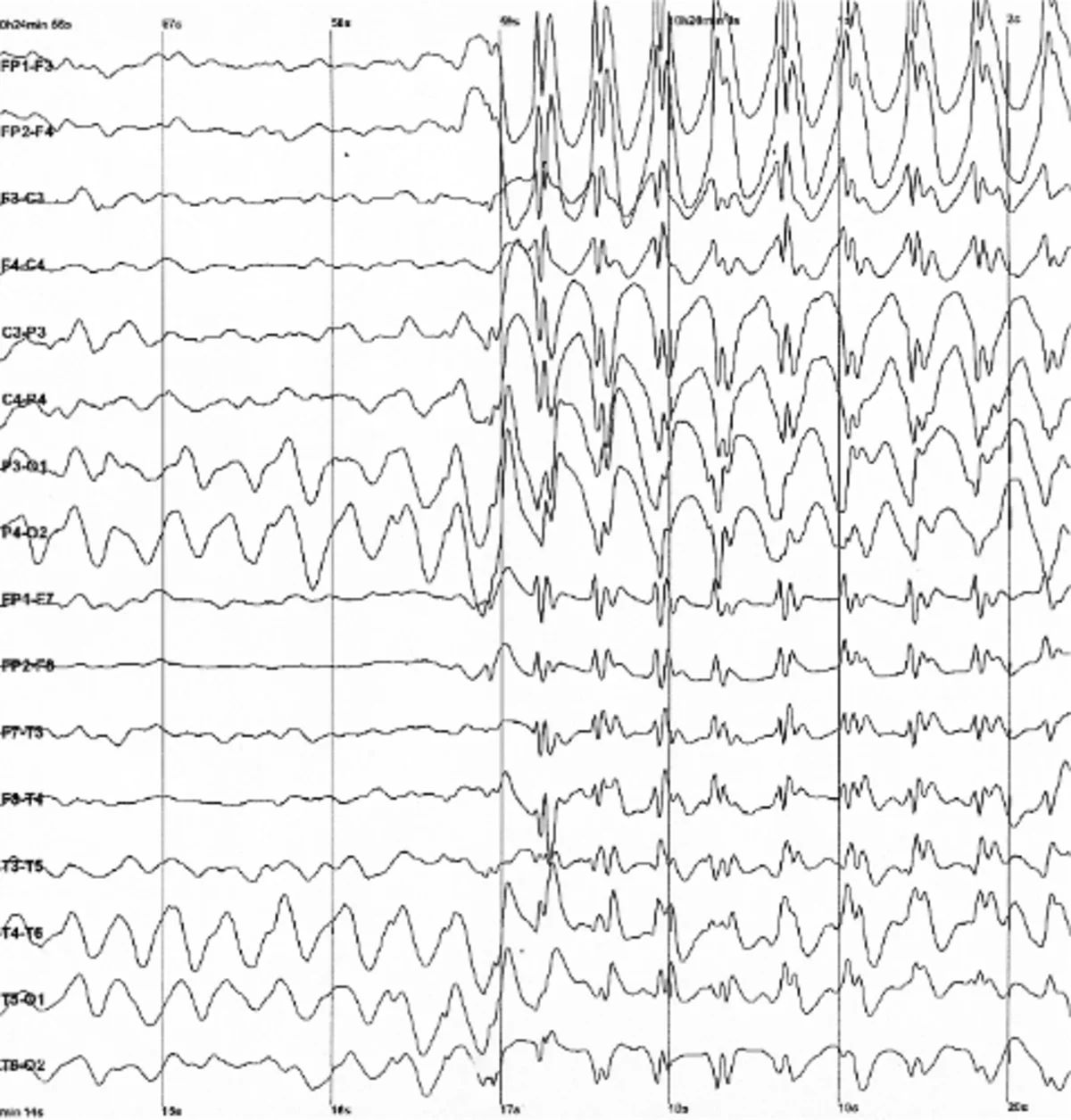 Spike and wave discharges monitored with EEG [source](https://en.wikipedia.org/wiki/Electroencephalography)